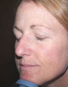Image result for Actinic Keratosis Treatment On Face