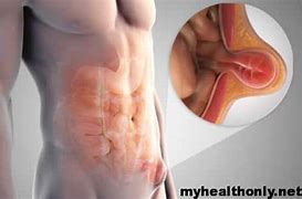 Image result for Lump Under Skin On Stomach