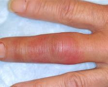 Image result for Swollen Finger Tip