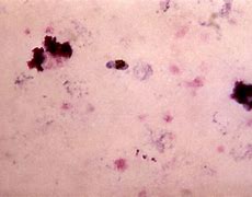 Image result for Inflammation vs Infection