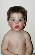 Image result for Fifths Disease Children
