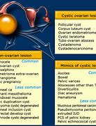 Image result for Cause of Paratubal Cyst