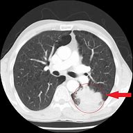 Image result for Lung Nodules On CT Scan