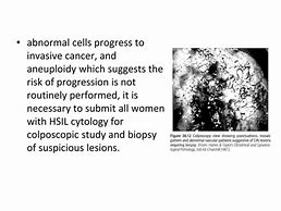 Image result for Cervical Intraepithelial Neoplasia