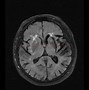 Image result for Fazekas CT Scan