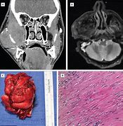 Image result for Infratemporal Fossa Tumors