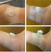 Image result for salicylic acid warts before and after
