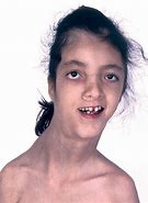 Image result for Proteus Syndrome