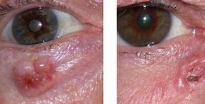 Image result for Basal Cell Carcinoma