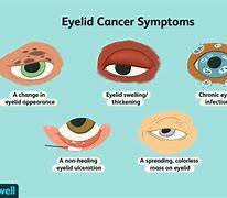 Image result for Eye Cancer Symptoms in Adults