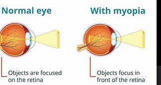 Image result for Congenital Myopia