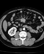 Image result for Carcinoid Tumor