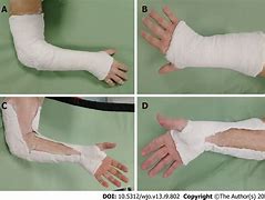 Image result for Full Arm Cast for ECU Injury