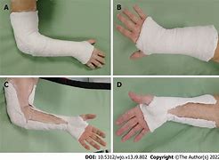Image result for Full Arm Cast for ECU Injury