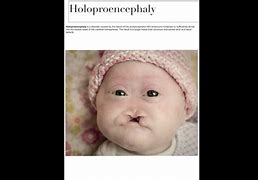Image result for Child with Alobar Holoprosencephaly
