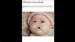 Image result for Holoprosencephaly Cyclops