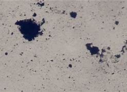 Image result for Verruca Under Microscope