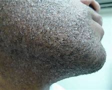 Image result for Folliculitis Beard