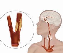 Image result for Surgery for Carotid Stenosis