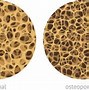 Image result for osteoporosis