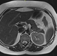 Image result for Pancreas MRI
