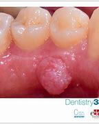 Image result for Gingival Papilloma