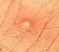 Image result for Ingrown Hair Blood Blister