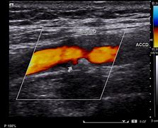 Image result for Carotid Ultrasound