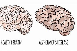 Image result for Brain with Alzheimer's