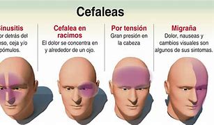 Image result for cefalea