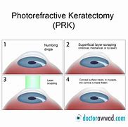 Image result for PRK Laser Eye Surgery