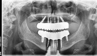Image result for X-ray of Dental Implant