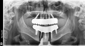 Image result for All On X Dental Implants