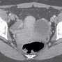 Image result for LT Adnexal Cyst in MRI