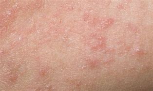Image result for Contact Dermatitis Bumps