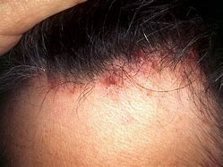 Image result for Scalp Folliculitis Hair