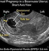 Image result for 9 Weeks Pregnant Images