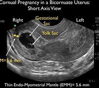Image result for 9 Weeks Pregnant with Twins