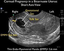 Image result for Ultrasound at 9 Weeks