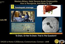 Image result for Chole Drain