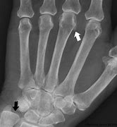 Image result for Bone Spur Knuckle Joint