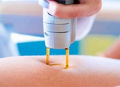 Image result for At-Home Laser Hair Removal