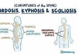 Image result for Spine with Scoliosis