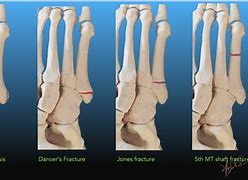 Image result for Proximal 5th Metatarsal Fracture
