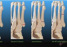 Image result for Jones Fracture vs Dancers Fracture