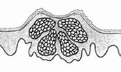 Image result for Molluscum Contagiosum Legs