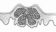 Image result for Molluscum Dermoscopy