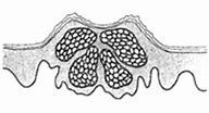 Image result for Dermatoscope of Molluscum Contagiosum