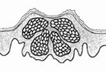 Image result for Molluscum Contagiosum Lesions