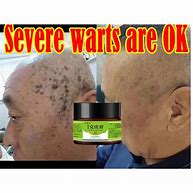 Image result for Kulugo Treatment